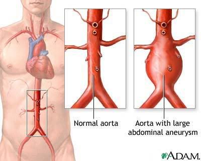 main leg(iliac) arteries.