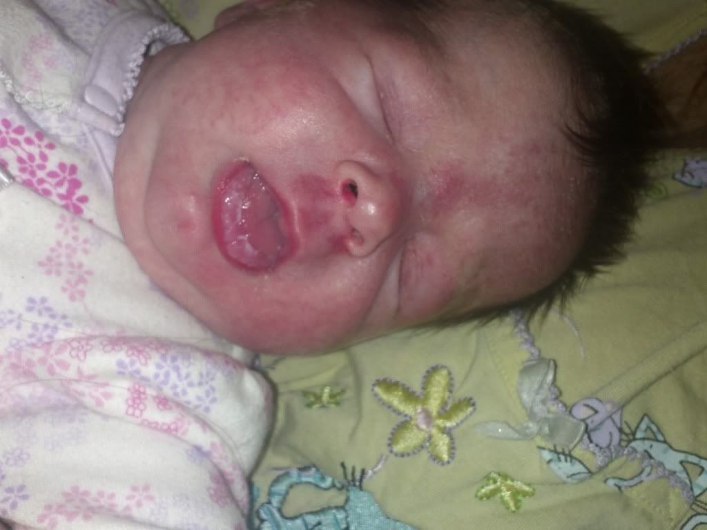 Stork bites!? Page 5 BabyCenter
